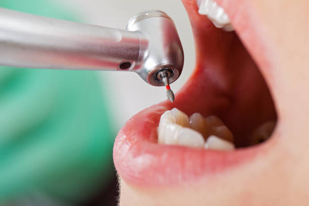 Best Emergency Dentist for Knocked-Out Tooth in USA